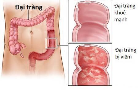viem-dai-trang-doca.jpg